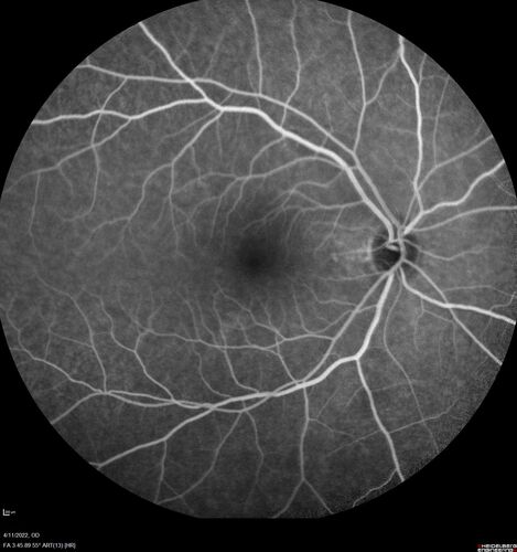 Acute Syphilitic Posterior Placoid Chorioretinitis
40 year old man About 10 days ago the patient woke up with a dark circle in the middle of the left eye that blocks his vision.Â  He thought it might be from fatigue.Â  The month of March was very stressful.Â  After a few days the spot in the left eye got darker and he could not drive at night.Â  During the last week while not going to work and sleeping more his vision is better but not normal.Â  He has never had vision loss in the past.Â Â 
PMHx: Benign,  Meds: Multivitamin
VA OD: sc20/16 NscJ1+VA OS: sc20/32+2 NscJ4
IOP: TP: OD:12 OS:12
