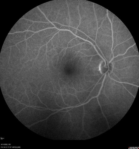 Acute Syphilitic Posterior Placoid Chorioretinitis
40 year old man About 10 days ago the patient woke up with a dark circle in the middle of the left eye that blocks his vision.Â  He thought it might be from fatigue.Â  The month of March was very stressful.Â  After a few days the spot in the left eye got darker and he could not drive at night.Â  During the last week while not going to work and sleeping more his vision is better but not normal.Â  He has never had vision loss in the past.Â Â 
PMHx: Benign,  Meds: Multivitamin
VA OD: sc20/16 NscJ1+VA OS: sc20/32+2 NscJ4
IOP: TP: OD:12 OS:12
