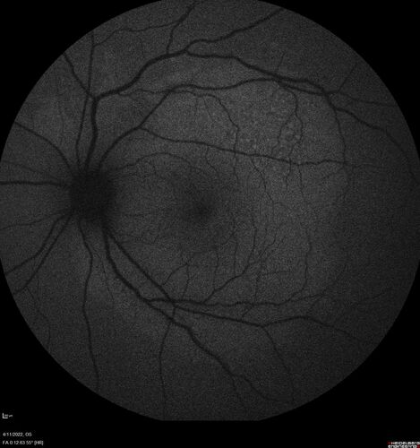 Acute Syphilitic Posterior Placoid Chorioretinitis
40 year old man About 10 days ago the patient woke up with a dark circle in the middle of the left eye that blocks his vision.Â  He thought it might be from fatigue.Â  The month of March was very stressful.Â  After a few days the spot in the left eye got darker and he could not drive at night.Â  During the last week while not going to work and sleeping more his vision is better but not normal.Â  He has never had vision loss in the past.Â Â 
PMHx: Benign,  Meds: Multivitamin
VA OD: sc20/16 NscJ1+VA OS: sc20/32+2 NscJ4
IOP: TP: OD:12 OS:12
