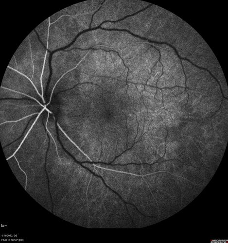 Acute Syphilitic Posterior Placoid Chorioretinitis
40 year old man About 10 days ago the patient woke up with a dark circle in the middle of the left eye that blocks his vision.Â  He thought it might be from fatigue.Â  The month of March was very stressful.Â  After a few days the spot in the left eye got darker and he could not drive at night.Â  During the last week while not going to work and sleeping more his vision is better but not normal.Â  He has never had vision loss in the past.Â Â 
PMHx: Benign,  Meds: Multivitamin
VA OD: sc20/16 NscJ1+VA OS: sc20/32+2 NscJ4
IOP: TP: OD:12 OS:12
