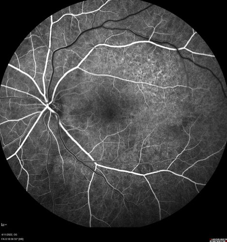 Acute Syphilitic Posterior Placoid Chorioretinitis
40 year old man About 10 days ago the patient woke up with a dark circle in the middle of the left eye that blocks his vision.Â  He thought it might be from fatigue.Â  The month of March was very stressful.Â  After a few days the spot in the left eye got darker and he could not drive at night.Â  During the last week while not going to work and sleeping more his vision is better but not normal.Â  He has never had vision loss in the past.Â Â 
PMHx: Benign,  Meds: Multivitamin
VA OD: sc20/16 NscJ1+VA OS: sc20/32+2 NscJ4
IOP: TP: OD:12 OS:12

