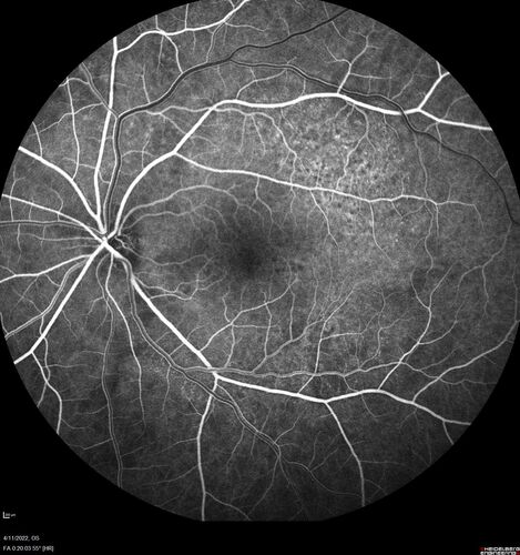 Acute Syphilitic Posterior Placoid Chorioretinitis
40 year old man About 10 days ago the patient woke up with a dark circle in the middle of the left eye that blocks his vision.Â  He thought it might be from fatigue.Â  The month of March was very stressful.Â  After a few days the spot in the left eye got darker and he could not drive at night.Â  During the last week while not going to work and sleeping more his vision is better but not normal.Â  He has never had vision loss in the past.Â Â 
PMHx: Benign,  Meds: Multivitamin
VA OD: sc20/16 NscJ1+VA OS: sc20/32+2 NscJ4
IOP: TP: OD:12 OS:12
