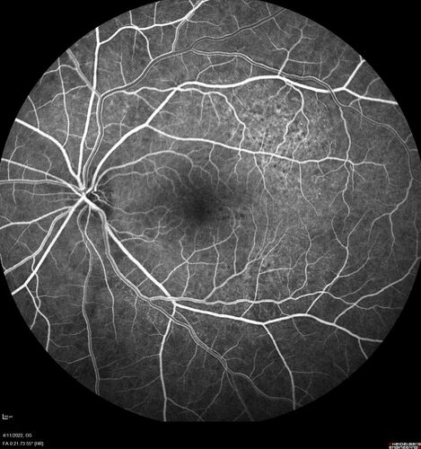 Acute Syphilitic Posterior Placoid Chorioretinitis
40 year old man About 10 days ago the patient woke up with a dark circle in the middle of the left eye that blocks his vision.Â  He thought it might be from fatigue.Â  The month of March was very stressful.Â  After a few days the spot in the left eye got darker and he could not drive at night.Â  During the last week while not going to work and sleeping more his vision is better but not normal.Â  He has never had vision loss in the past.Â Â 
PMHx: Benign,  Meds: Multivitamin
VA OD: sc20/16 NscJ1+VA OS: sc20/32+2 NscJ4
IOP: TP: OD:12 OS:12
