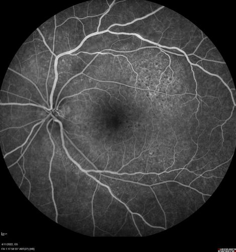 Acute Syphilitic Posterior Placoid Chorioretinitis
40 year old man About 10 days ago the patient woke up with a dark circle in the middle of the left eye that blocks his vision.Â  He thought it might be from fatigue.Â  The month of March was very stressful.Â  After a few days the spot in the left eye got darker and he could not drive at night.Â  During the last week while not going to work and sleeping more his vision is better but not normal.Â  He has never had vision loss in the past.Â Â 
PMHx: Benign,  Meds: Multivitamin
VA OD: sc20/16 NscJ1+VA OS: sc20/32+2 NscJ4
IOP: TP: OD:12 OS:12
