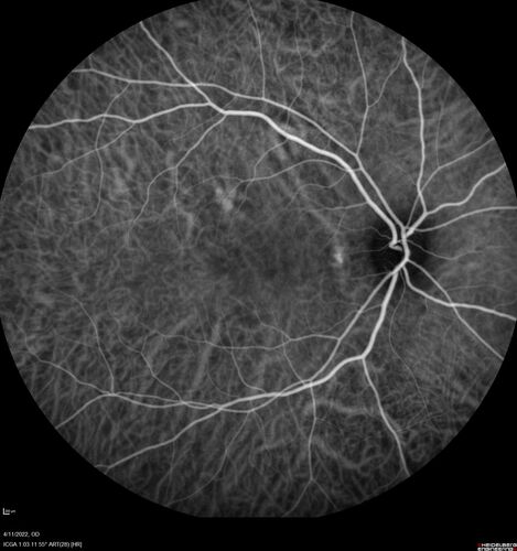 Acute Syphilitic Posterior Placoid Chorioretinitis
40 year old man About 10 days ago the patient woke up with a dark circle in the middle of the left eye that blocks his vision.Â  He thought it might be from fatigue.Â  The month of March was very stressful.Â  After a few days the spot in the left eye got darker and he could not drive at night.Â  During the last week while not going to work and sleeping more his vision is better but not normal.Â  He has never had vision loss in the past.Â Â 
PMHx: Benign,  Meds: Multivitamin
VA OD: sc20/16 NscJ1+VA OS: sc20/32+2 NscJ4
IOP: TP: OD:12 OS:12
