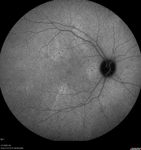 Acute Syphilitic Posterior Placoid Chorioretinitis
40 year old man About 10 days ago the patient woke up with a dark circle in the middle of the left eye that blocks his vision.Â  He thought it might be from fatigue.Â  The month of March was very stressful.Â  After a few days the spot in the left eye got darker and he could not drive at night.Â  During the last week while not going to work and sleeping more his vision is better but not normal.Â  He has never had vision loss in the past.Â Â 
PMHx: Benign,  Meds: Multivitamin
VA OD: sc20/16 NscJ1+VA OS: sc20/32+2 NscJ4
IOP: TP: OD:12 OS:12
