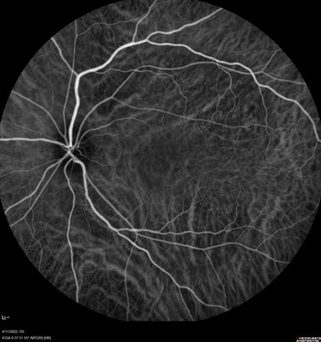 Acute Syphilitic Posterior Placoid Chorioretinitis
40 year old man About 10 days ago the patient woke up with a dark circle in the middle of the left eye that blocks his vision.Â  He thought it might be from fatigue.Â  The month of March was very stressful.Â  After a few days the spot in the left eye got darker and he could not drive at night.Â  During the last week while not going to work and sleeping more his vision is better but not normal.Â  He has never had vision loss in the past.Â Â 
PMHx: Benign,  Meds: Multivitamin
VA OD: sc20/16 NscJ1+VA OS: sc20/32+2 NscJ4
IOP: TP: OD:12 OS:12
