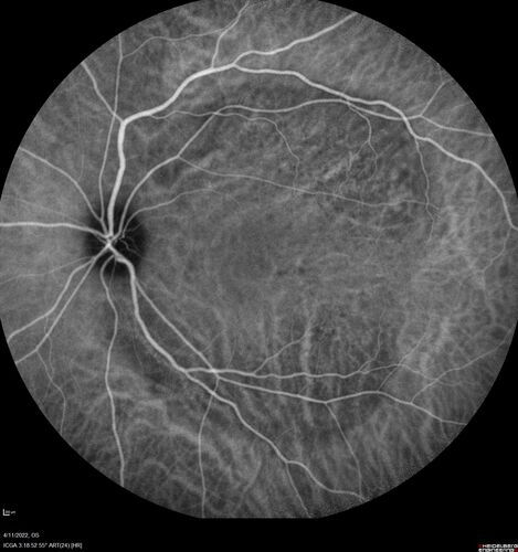 Acute Syphilitic Posterior Placoid Chorioretinitis
40 year old man About 10 days ago the patient woke up with a dark circle in the middle of the left eye that blocks his vision.Â  He thought it might be from fatigue.Â  The month of March was very stressful.Â  After a few days the spot in the left eye got darker and he could not drive at night.Â  During the last week while not going to work and sleeping more his vision is better but not normal.Â  He has never had vision loss in the past.Â Â 
PMHx: Benign,  Meds: Multivitamin
VA OD: sc20/16 NscJ1+VA OS: sc20/32+2 NscJ4
IOP: TP: OD:12 OS:12
