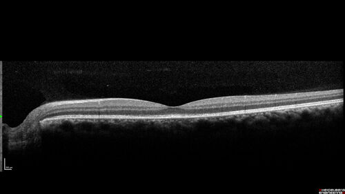 Syphilitic Chorioretinitis - 1 month post-treatment
41 year old man with vision loss for five days left eye.  VA 20/32, 20/200
