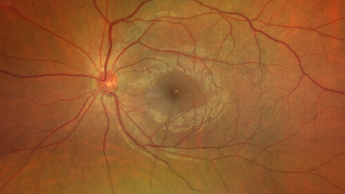 Acute Syphilitic Posterior Placoid Chorioretinitis
40 year old man About 10 days ago the patient woke up with a dark circle in the middle of the left eye that blocks his vision.Â  He thought it might be from fatigue.Â  The month of March was very stressful.Â  After a few days the spot in the left eye got darker and he could not drive at night.Â  During the last week while not going to work and sleeping more his vision is better but not normal.Â  He has never had vision loss in the past.Â Â 
PMHx: Benign,  Meds: Multivitamin
VA OD: sc20/16 NscJ1+VA OS: sc20/32+2 NscJ4
IOP: TP: OD:12 OS:12
