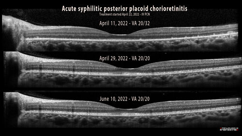 Acute Syphilitic Posterior Placoid Chorioretinitis
40 year old man About 10 days ago the patient woke up with a dark circle in the middle of the left eye that blocks his vision.Â  He thought it might be from fatigue.Â  The month of March was very stressful.Â  After a few days the spot in the left eye got darker and he could not drive at night.Â  During the last week while not going to work and sleeping more his vision is better but not normal.Â  He has never had vision loss in the past.Â Â 
PMHx: Benign,  Meds: Multivitamin
VA OD: sc20/16 NscJ1+VA OS: sc20/32+2 NscJ4
IOP: TP: OD:12 OS:12
