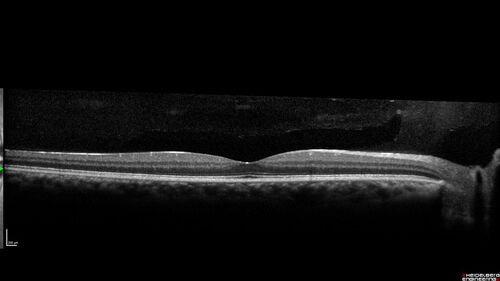 Syphilitic Chorioretinitis - 2 month post-treatment
41 year old man with vision loss for five days left eye.  VA 20/32, 20/200
