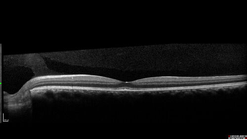 Syphilitic Chorioretinitis - 2 month post-treatment
41 year old man with vision loss for five days left eye.  VA 20/32, 20/200
