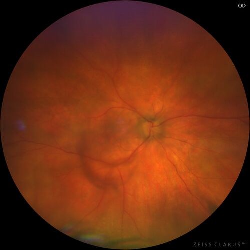 Severe Syphilitic Placoid Chorioretinitis
68 year old man 3 months ago the vision started fading in both eyes.  Just sitting here he can see some light out of his right eye. The patient denies any recent illness or travel.  
VA: OD: LP, OS: 4/200
IOP: 9, 13
Anterior segment: 1+ cell/ 2+ flare OU and 2+ NS and anterior vitreous cells
Labs Reactive RPR 1:256, FTA-ABS - reactive - Patient was admitted to hospital for IV PCN and recovered vision almost completely in the left eye and some in the right eye.
See line scans for recovery
