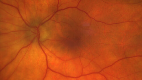 Severe Syphilitic Placoid Chorioretinitis
68 year old man 3 months ago the vision started fading in both eyes.  Just sitting here he can see some light out of his right eye. The patient denies any recent illness or travel.  
VA: OD: LP, OS: 4/200
IOP: 9, 13
Anterior segment: 1+ cell/ 2+ flare OU and 2+ NS and anterior vitreous cells
Labs Reactive RPR 1:256, FTA-ABS - reactive - Patient was admitted to hospital for IV PCN and recovered vision almost completely in the left eye and some in the right eye.
See line scans for recovery
