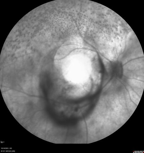 Severe Syphilitic Placoid Chorioretinitis
68 year old man 3 months ago the vision started fading in both eyes.  Just sitting here he can see some light out of his right eye. The patient denies any recent illness or travel.  
VA: OD: LP, OS: 4/200
IOP: 9, 13
Anterior segment: 1+ cell/ 2+ flare OU and 2+ NS and anterior vitreous cells
Labs Reactive RPR 1:256, FTA-ABS - reactive - Patient was admitted to hospital for IV PCN and recovered vision almost completely in the left eye and some in the right eye.
See line scans for recovery

