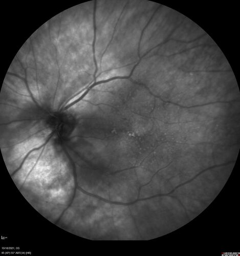 Severe Syphilitic Placoid Chorioretinitis
68 year old man 3 months ago the vision started fading in both eyes.  Just sitting here he can see some light out of his right eye. The patient denies any recent illness or travel.  
VA: OD: LP, OS: 4/200
IOP: 9, 13
Anterior segment: 1+ cell/ 2+ flare OU and 2+ NS and anterior vitreous cells
Labs Reactive RPR 1:256, FTA-ABS - reactive - Patient was admitted to hospital for IV PCN and recovered vision almost completely in the left eye and some in the right eye.
See line scans for recovery
