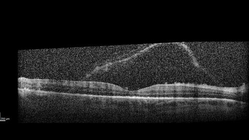 Severe Syphilitic Placoid Chorioretinitis
68 year old man 3 months ago the vision started fading in both eyes.  Just sitting here he can see some light out of his right eye. The patient denies any recent illness or travel.  
VA: OD: LP, OS: 4/200
IOP: 9, 13
Anterior segment: 1+ cell/ 2+ flare OU and 2+ NS and anterior vitreous cells
Labs Reactive RPR 1:256, FTA-ABS - reactive - Patient was admitted to hospital for IV PCN and recovered vision almost completely in the left eye and some in the right eye.
See line scans for recovery
