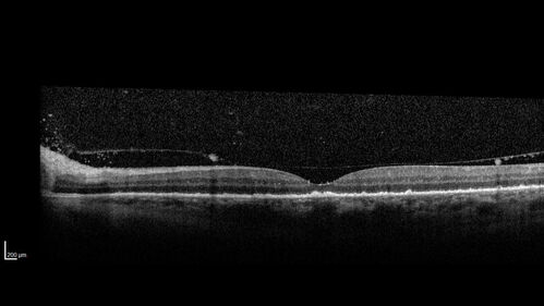 Severe Syphilitic Placoid Chorioretinitis
68 year old man 3 months ago the vision started fading in both eyes.  Just sitting here he can see some light out of his right eye. The patient denies any recent illness or travel.  
VA: OD: LP, OS: 4/200
IOP: 9, 13
Anterior segment: 1+ cell/ 2+ flare OU and 2+ NS and anterior vitreous cells
Labs Reactive RPR 1:256, FTA-ABS - reactive - Patient was admitted to hospital for IV PCN and recovered vision almost completely in the left eye and some in the right eye.
See line scans for recovery
