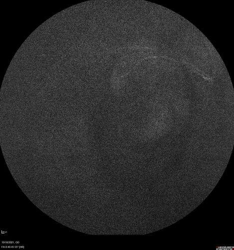 Severe Syphilitic Placoid Chorioretinitis
68 year old man 3 months ago the vision started fading in both eyes.  Just sitting here he can see some light out of his right eye. The patient denies any recent illness or travel.  
VA: OD: LP, OS: 4/200
IOP: 9, 13
Anterior segment: 1+ cell/ 2+ flare OU and 2+ NS and anterior vitreous cells
Labs Reactive RPR 1:256, FTA-ABS - reactive - Patient was admitted to hospital for IV PCN and recovered vision almost completely in the left eye and some in the right eye.
See line scans for recovery
