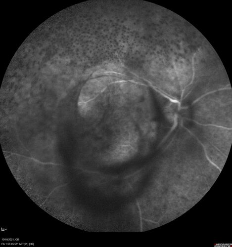 Severe Syphilitic Placoid Chorioretinitis
68 year old man 3 months ago the vision started fading in both eyes.  Just sitting here he can see some light out of his right eye. The patient denies any recent illness or travel.  
VA: OD: LP, OS: 4/200
IOP: 9, 13
Anterior segment: 1+ cell/ 2+ flare OU and 2+ NS and anterior vitreous cells
Labs Reactive RPR 1:256, FTA-ABS - reactive - Patient was admitted to hospital for IV PCN and recovered vision almost completely in the left eye and some in the right eye.
See line scans for recovery
