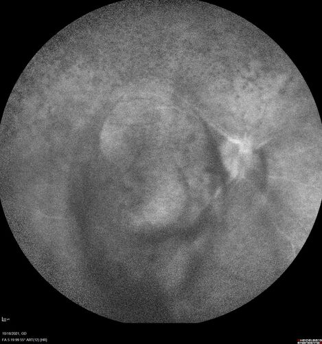 Severe Syphilitic Placoid Chorioretinitis
68 year old man 3 months ago the vision started fading in both eyes.  Just sitting here he can see some light out of his right eye. The patient denies any recent illness or travel.  
VA: OD: LP, OS: 4/200
IOP: 9, 13
Anterior segment: 1+ cell/ 2+ flare OU and 2+ NS and anterior vitreous cells
Labs Reactive RPR 1:256, FTA-ABS - reactive - Patient was admitted to hospital for IV PCN and recovered vision almost completely in the left eye and some in the right eye.
See line scans for recovery
