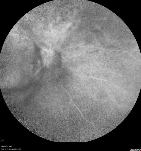 Severe Syphilitic Placoid Chorioretinitis
68 year old man 3 months ago the vision started fading in both eyes.  Just sitting here he can see some light out of his right eye. The patient denies any recent illness or travel.  
VA: OD: LP, OS: 4/200
IOP: 9, 13
Anterior segment: 1+ cell/ 2+ flare OU and 2+ NS and anterior vitreous cells
Labs Reactive RPR 1:256, FTA-ABS - reactive - Patient was admitted to hospital for IV PCN and recovered vision almost completely in the left eye and some in the right eye.
See line scans for recovery
