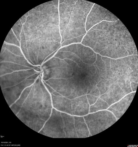 Severe Syphilitic Placoid Chorioretinitis
68 year old man 3 months ago the vision started fading in both eyes.  Just sitting here he can see some light out of his right eye. The patient denies any recent illness or travel.  
VA: OD: LP, OS: 4/200
IOP: 9, 13
Anterior segment: 1+ cell/ 2+ flare OU and 2+ NS and anterior vitreous cells
Labs Reactive RPR 1:256, FTA-ABS - reactive - Patient was admitted to hospital for IV PCN and recovered vision almost completely in the left eye and some in the right eye.
See line scans for recovery
