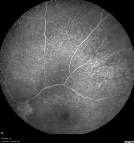 Severe Syphilitic Placoid Chorioretinitis
68 year old man 3 months ago the vision started fading in both eyes.  Just sitting here he can see some light out of his right eye. The patient denies any recent illness or travel.  
VA: OD: LP, OS: 4/200
IOP: 9, 13
Anterior segment: 1+ cell/ 2+ flare OU and 2+ NS and anterior vitreous cells
Labs Reactive RPR 1:256, FTA-ABS - reactive - Patient was admitted to hospital for IV PCN and recovered vision almost completely in the left eye and some in the right eye.
See line scans for recovery
