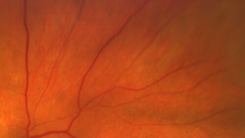 Severe Syphilitic Placoid Chorioretinitis
68 year old man 3 months ago the vision started fading in both eyes.  Just sitting here he can see some light out of his right eye. The patient denies any recent illness or travel.  
VA: OD: LP, OS: 4/200
IOP: 9, 13
Anterior segment: 1+ cell/ 2+ flare OU and 2+ NS and anterior vitreous cells
Labs Reactive RPR 1:256, FTA-ABS - reactive - Patient was admitted to hospital for IV PCN and recovered vision almost completely in the left eye and some in the right eye.
See line scans for recovery
