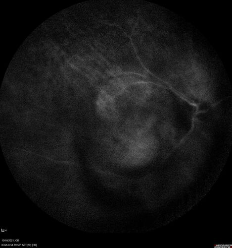 Severe Syphilitic Placoid Chorioretinitis
68 year old man 3 months ago the vision started fading in both eyes.  Just sitting here he can see some light out of his right eye. The patient denies any recent illness or travel.  
VA: OD: LP, OS: 4/200
IOP: 9, 13
Anterior segment: 1+ cell/ 2+ flare OU and 2+ NS and anterior vitreous cells
Labs Reactive RPR 1:256, FTA-ABS - reactive - Patient was admitted to hospital for IV PCN and recovered vision almost completely in the left eye and some in the right eye.
See line scans for recovery
