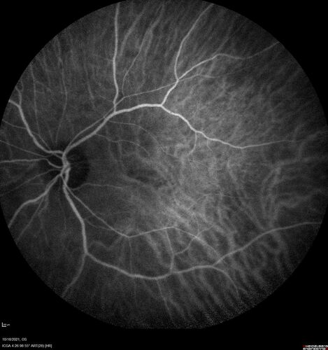 Severe Syphilitic Placoid Chorioretinitis
68 year old man 3 months ago the vision started fading in both eyes.  Just sitting here he can see some light out of his right eye. The patient denies any recent illness or travel.  
VA: OD: LP, OS: 4/200
IOP: 9, 13
Anterior segment: 1+ cell/ 2+ flare OU and 2+ NS and anterior vitreous cells
Labs Reactive RPR 1:256, FTA-ABS - reactive - Patient was admitted to hospital for IV PCN and recovered vision almost completely in the left eye and some in the right eye.
See line scans for recovery
