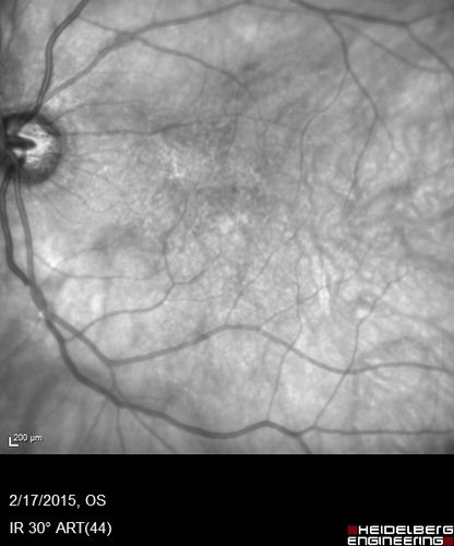 Lamellar macular hole
Wet AMD in right and better eye failed extend to 2 months but was able to stop therapy once he started on systemic Avastin for cancer.  The last image shows the macula dry 9 months without local therapy.  The left eye has a lamellar macular hole.
