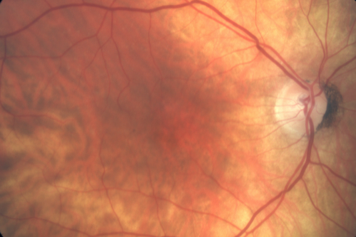Wet AMD OD and Lamellar Macular hole OS
Wet AMD in right and better eye failed extend to 2 months but was able to stop therapy once he started on systemic Avastin for cancer.  The last image shows the macula dry 9 months without local therapy.  The left eye has a lamellar macular hole.
