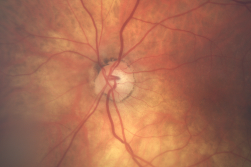 Wet AMD OD and Lamellar Macular hole OS
Wet AMD in right and better eye failed extend to 2 months but was able to stop therapy once he started on systemic Avastin for cancer.  The last image shows the macula dry 9 months without local therapy.  The left eye has a lamellar macular hole.

