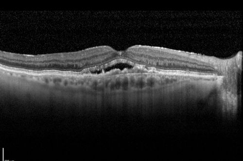 Wet AMD OD and Lamellar Macular hole OS
Wet AMD in right and better eye failed extend to 2 months but was able to stop therapy once he started on systemic Avastin for cancer.  The last image shows the macula dry 9 months without local therapy.  The left eye has a lamellar macular hole.
