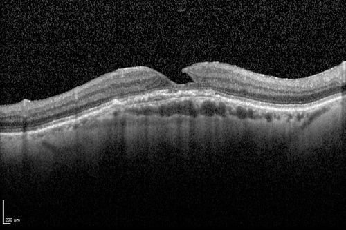 Wet AMD OD and Lamellar Macular hole OS
Wet AMD in right and better eye failed extend to 2 months but was able to stop therapy once he started on systemic Avastin for cancer.  The last image shows the macula dry 9 months without local therapy.  The left eye has a lamellar macular hole.
