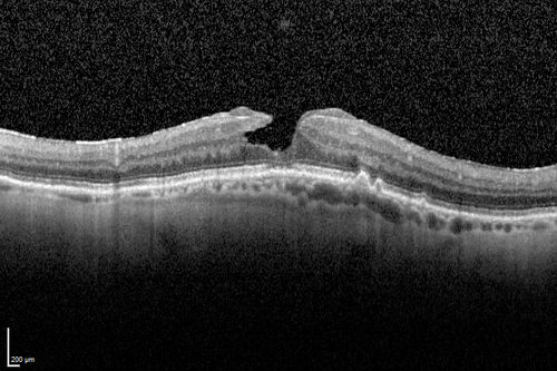 Wet AMD OD and Lamellar Macular hole OS
Wet AMD in right and better eye failed extend to 2 months but was able to stop therapy once he started on systemic Avastin for cancer.  The last image shows the macula dry 9 months without local therapy.  The left eye has a lamellar macular hole.
