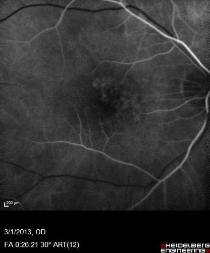 Wet AMD OD and Lamellar Macular hole OS
Wet AMD in right and better eye failed extend to 2 months but was able to stop therapy once he started on systemic Avastin for cancer.  The last image shows the macula dry 9 months without local therapy.  The left eye has a lamellar macular hole.
