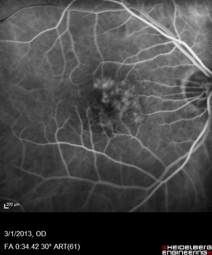 Wet AMD OD and Lamellar Macular hole OS
Wet AMD in right and better eye failed extend to 2 months but was able to stop therapy once he started on systemic Avastin for cancer.  The last image shows the macula dry 9 months without local therapy.  The left eye has a lamellar macular hole.
