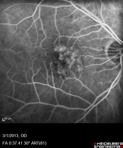 Wet AMD OD and Lamellar Macular hole OS
Wet AMD in right and better eye failed extend to 2 months but was able to stop therapy once he started on systemic Avastin for cancer.  The last image shows the macula dry 9 months without local therapy.  The left eye has a lamellar macular hole.
