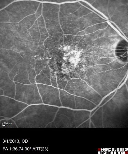 Wet AMD OD and Lamellar Macular hole OS
Wet AMD in right and better eye failed extend to 2 months but was able to stop therapy once he started on systemic Avastin for cancer.  The last image shows the macula dry 9 months without local therapy.  The left eye has a lamellar macular hole.
