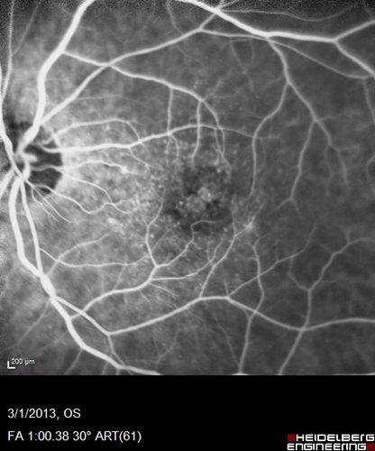 Wet AMD OD and Lamellar Macular hole OS
Wet AMD in right and better eye failed extend to 2 months but was able to stop therapy once he started on systemic Avastin for cancer.  The last image shows the macula dry 9 months without local therapy.  The left eye has a lamellar macular hole.
