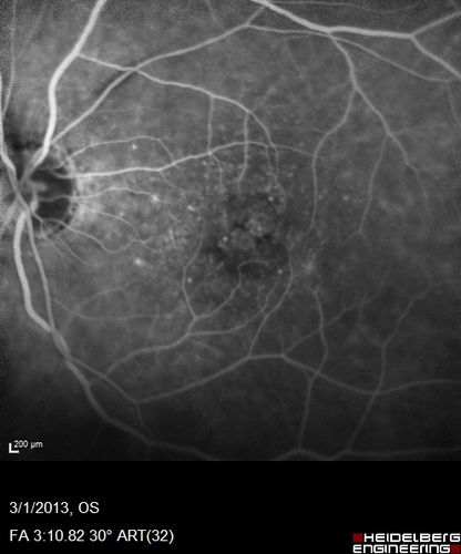 Wet AMD OD and Lamellar Macular hole OS
Wet AMD in right and better eye failed extend to 2 months but was able to stop therapy once he started on systemic Avastin for cancer.  The last image shows the macula dry 9 months without local therapy.  The left eye has a lamellar macular hole.
