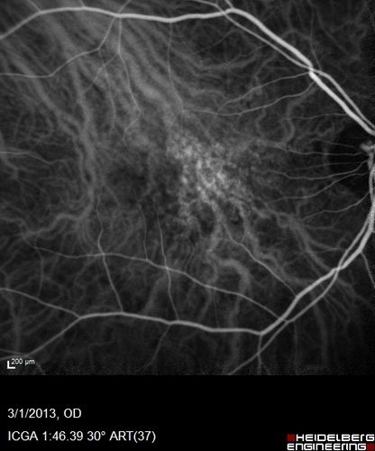 Wet AMD OD and Lamellar Macular hole OS
Wet AMD in right and better eye failed extend to 2 months but was able to stop therapy once he started on systemic Avastin for cancer.  The last image shows the macula dry 9 months without local therapy.  The left eye has a lamellar macular hole.
