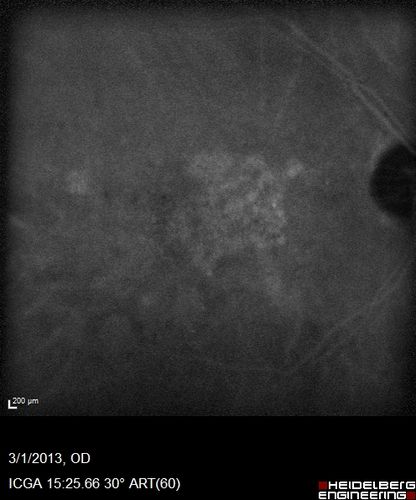 Wet AMD OD and Lamellar Macular hole OS
Wet AMD in right and better eye failed extend to 2 months but was able to stop therapy once he started on systemic Avastin for cancer.  The last image shows the macula dry 9 months without local therapy.  The left eye has a lamellar macular hole.
