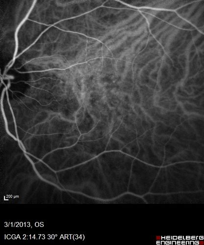 Wet AMD OD and Lamellar Macular hole OS
Wet AMD in right and better eye failed extend to 2 months but was able to stop therapy once he started on systemic Avastin for cancer.  The last image shows the macula dry 9 months without local therapy.  The left eye has a lamellar macular hole.
