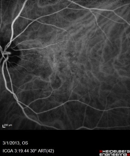 Wet AMD OD and Lamellar Macular hole OS
Wet AMD in right and better eye failed extend to 2 months but was able to stop therapy once he started on systemic Avastin for cancer.  The last image shows the macula dry 9 months without local therapy.  The left eye has a lamellar macular hole.
