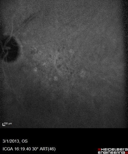 Wet AMD OD and Lamellar Macular hole OS
Wet AMD in right and better eye failed extend to 2 months but was able to stop therapy once he started on systemic Avastin for cancer.  The last image shows the macula dry 9 months without local therapy.  The left eye has a lamellar macular hole.
