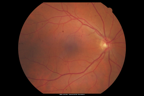 Retinal Tear Before Laser
65-year-old woman new onset floaters for 1 week.  She initially saw flashing lights and then the flashing lights subsided and then she had the floaters VISUAL ACUITY:  OD 20/25,  OS 20/50
